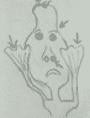 Creating Memorable Pediatric Mnemonics Mnemonic cartoon showing fused fingers and early cranial suture closure to help remember key features of Apert syndrome