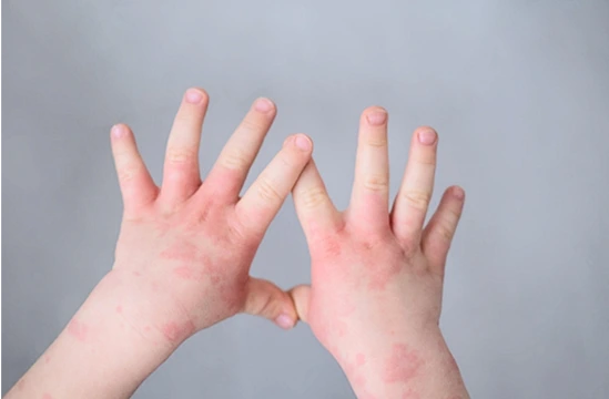 Tools to help you pass Example of a pediatric hand rash shown in the PBR sample dermatology chapter to help learners recognize common dermatologic findings on the boards